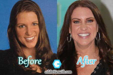 stephanie mcmahon boob|Stephanie McMahon Plastic Surgery: Before and After Her Boob Job